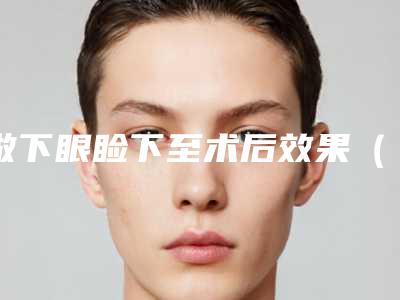 做下眼睑下至术后效果(做完眼睑下至)